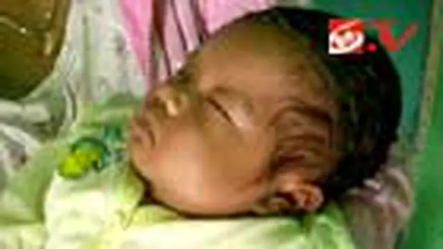 Kondisi Bayi Menangis Darah Membaik
