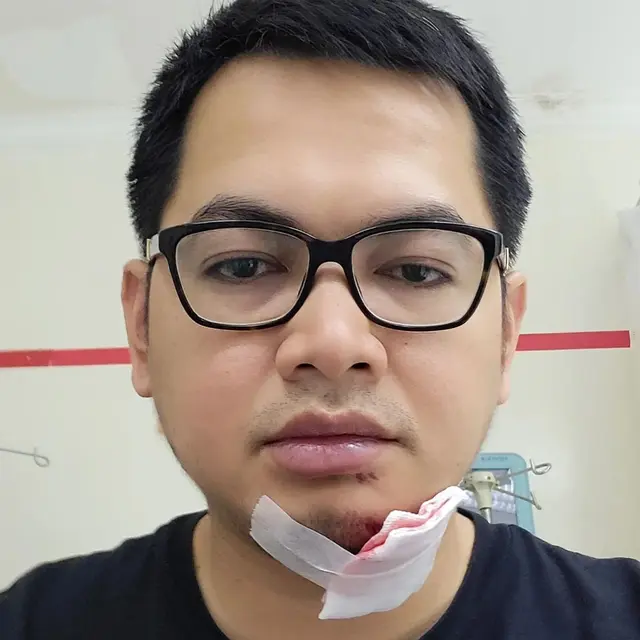 Jatuh hingga Alami Robek di Dagu, Ini 6 Potret Kondisi Tommy Kurniawan