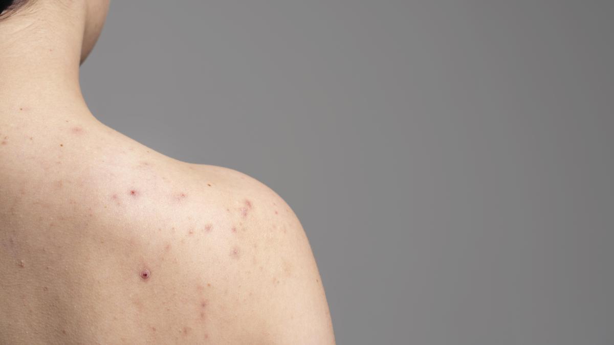 Solusi Back-Acne yang Membuatmu Tidak Percaya Diri