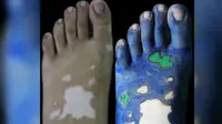 Menderita Vitiligo, Gadis India Ubah Bercak Kulit Jadi Karya Seni
