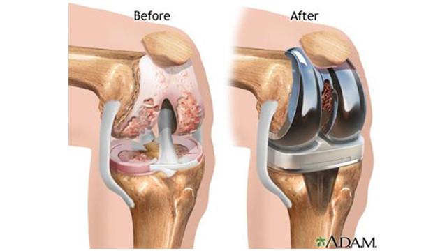 Kenali Lebih Dini Osteoporosis dan Osteoarthritis