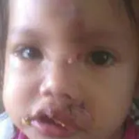 Bocah asal Sumatera Selatan ini mengalami kecelakaan di wajahnya. Namun dokter di RSU malah menjahit lukanya secara asal-asalan!