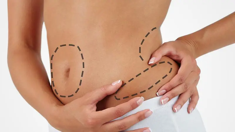 Berapa Banyak Lemak yang Diambil Saat Liposuction? - Health Liputan6.com