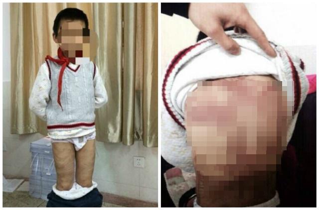Anak 9 tahun penuh bekas luka di sekujur tubuhnya | Photo: Copyright shanghaiist.com