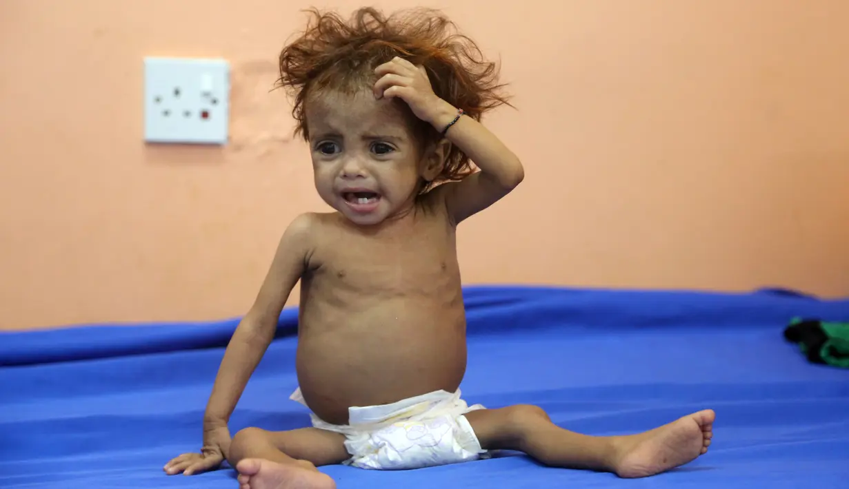 Seorang anak Yaman menderita malnutrisi menunggu menerima perawatan di sebuah rumah sakit di kota Hodeidah, Yaman (8/4). Jutaan orang kelaparan di Yaman setelah dua tahun konflik antara koalisi pimpinan Saudi dan pemberontak Houthi. (AFP Photo/Abdo Hyder)