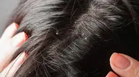 Garam dapat digunakan untuk mengurangi ketombe di area rambut yang ada di kepala