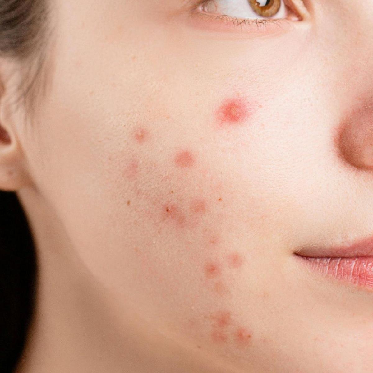 Doa Menghilangkan Jerawat dan Bisul, Acne Fighter Wajib Tahu!