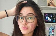 6 Potret Pede Gabriella Ekaputri dengan Wajah Penuh Jerawat, Tak Malu Foto Tanpa Makeup