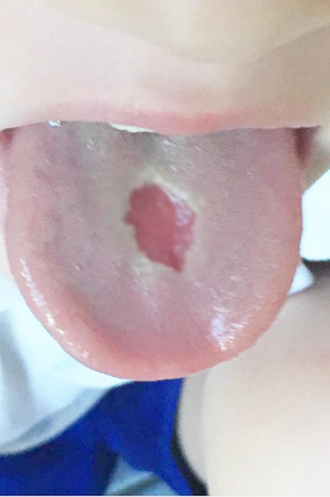 Lidah berlubang akibat makan permen asam | foto: copyright metro.co.uk