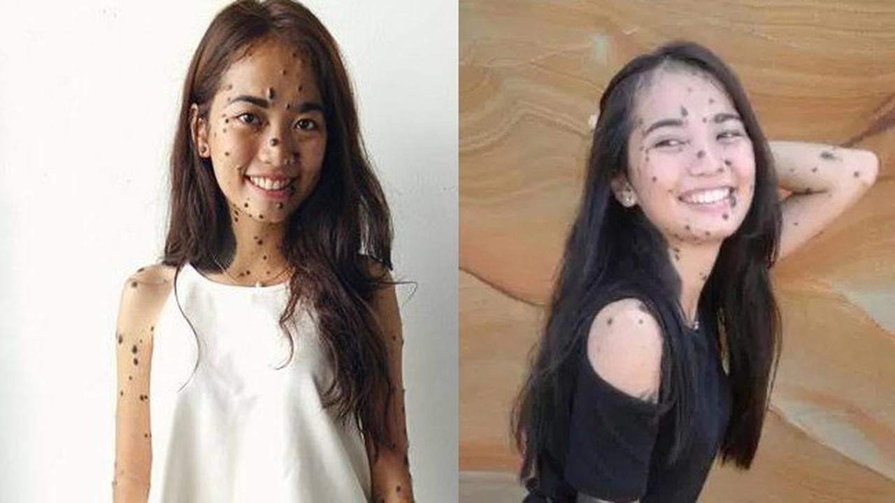 Berwajah Penuh Tahi Lalat, Gadis Ini Justru Jadi Inspitrator