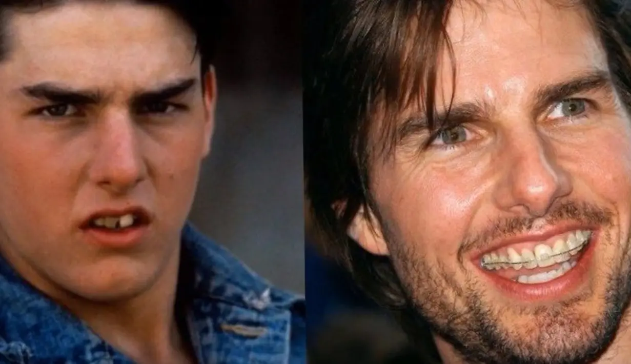 Tom Cruise memutuskan untuk memutuskan untuk melakukan perawatan kawat gigi di usia 40 tahun. (Plastic Surgery)