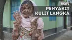 Seorang wanita dijuluki 'wanita kentang' karena menderita penyakit langka. Sekujur tubuhnya ditumbuhi tumor