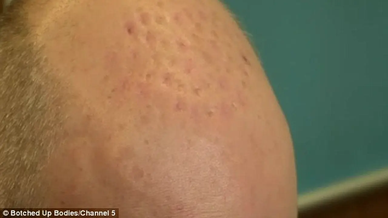 Transplantasi Rambut Bikin Kepala Ryder Seperti Bekas Digigit