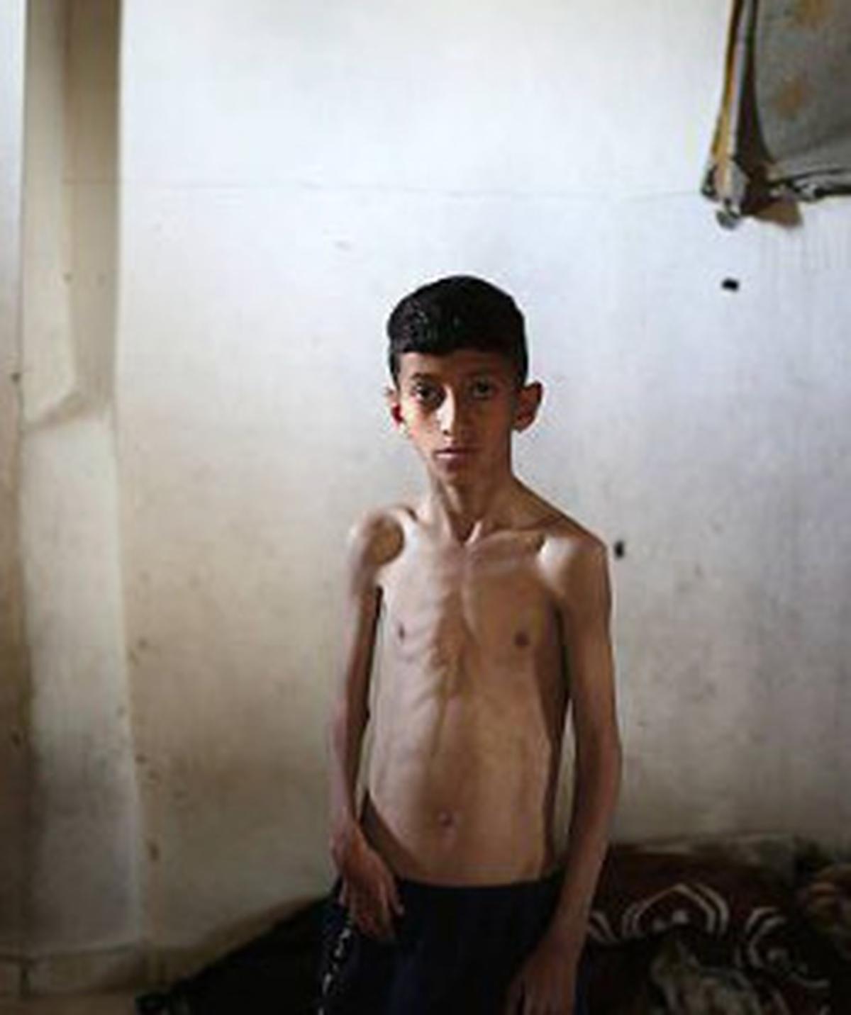 Anak di Gaza Alami Kelaparan