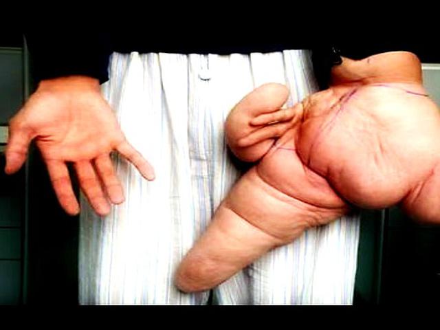 Tangan Terus Membesar Bak Raksasa Pria Ini Dikucilkan Warga Health Liputan6 Com