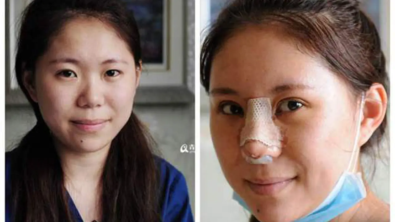 Muak dengan Makeup, Wanita Ini Pilih Operasi Plastik