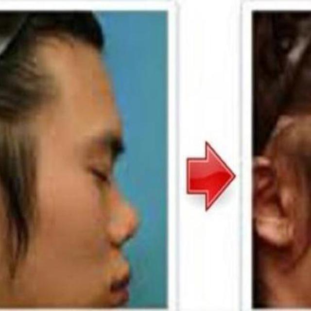 Tanpa Operasi Ini 6 Cara Alami Bikin Hidung Jadi Mancung Citizen6 Liputan6 Com