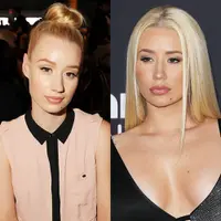 Iggy Azalea secara terang-teranga mengaku operasi hidung. Begini penampilan before-afternya.(REX/Shutterstock/HollywoodLife)