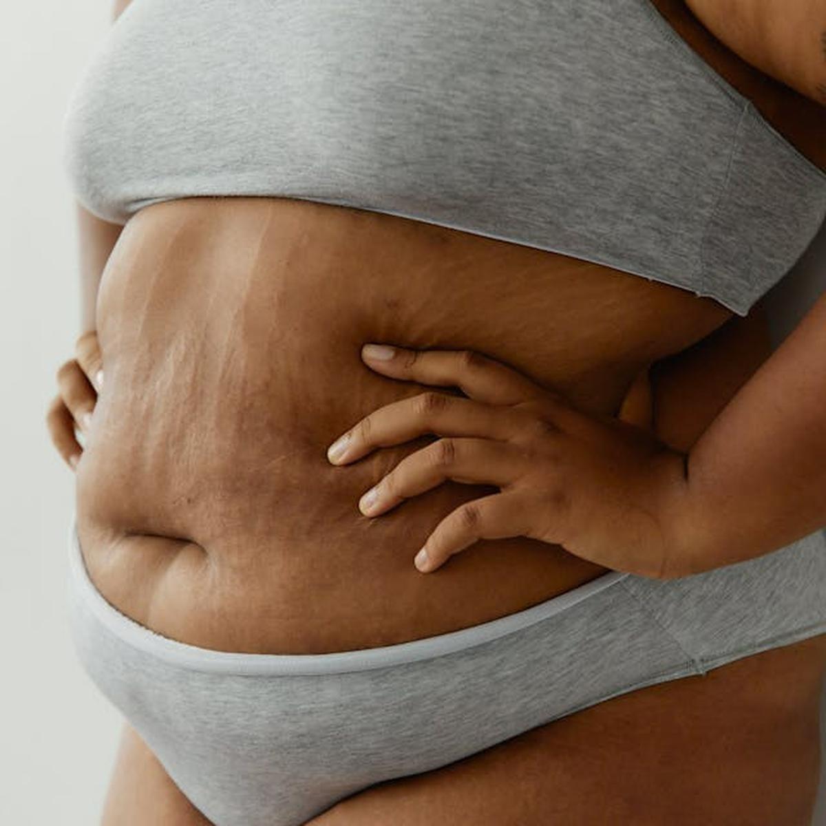 Masalah Kulit yang Bisa Dialami Penderita Obesitas