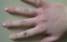 5 Cara Mengatasi Alergi Obat Secara Alami, Aman dan Efektif