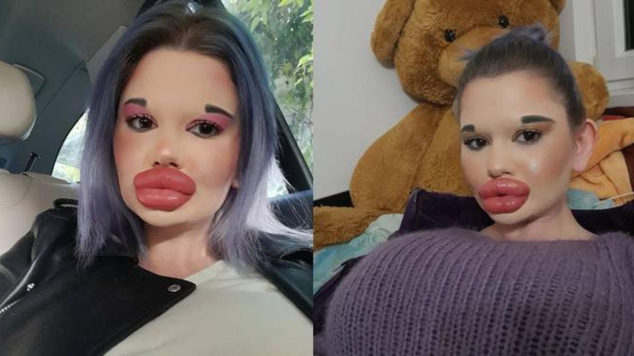 Ingin Tampil Bak Boneka, Wanita Akan Injeksi Bibir Ke 27 Kali Akhir Tahun Ini