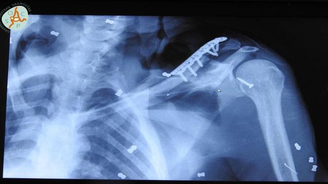 Orang utan Hope dengan 74 peluru senapan angin sedang dalam perawatan usai menjalani operasi tulang bahu. (Dok YEL-SOCP/Suryadi)