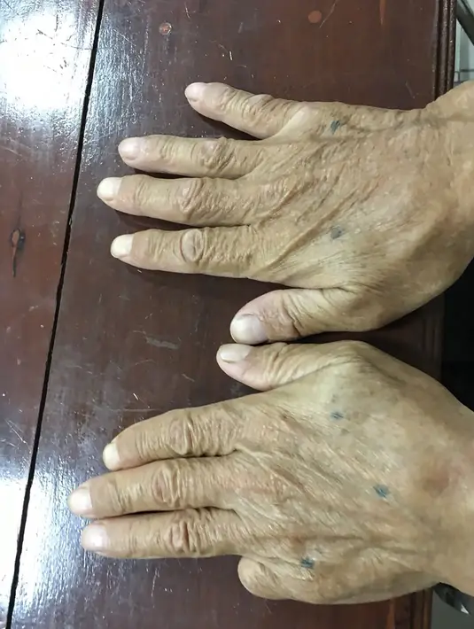 Tangan Shigeharu Shirai dengan jari kelingkingnya hilang di kantor polisi di Lopburi, Thailand, Kamis, (11/1). Otoritas Jepang memburu Shirai atas keterlibatannya dalam penembakan seseorang yang menjadi musuhnya di Jepang pada tahun 2003 lalu. (AFP Photo)