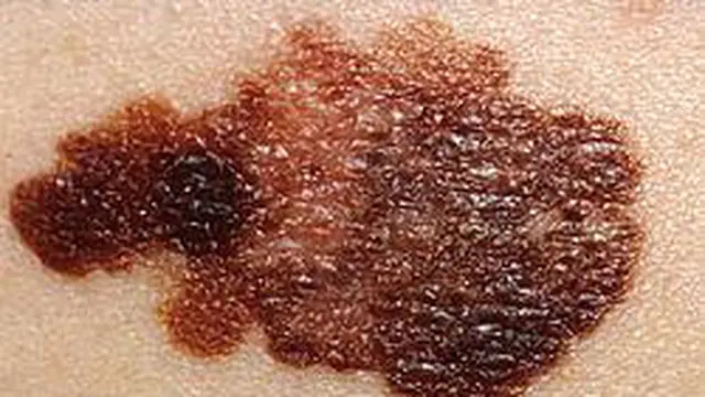 Melanoma