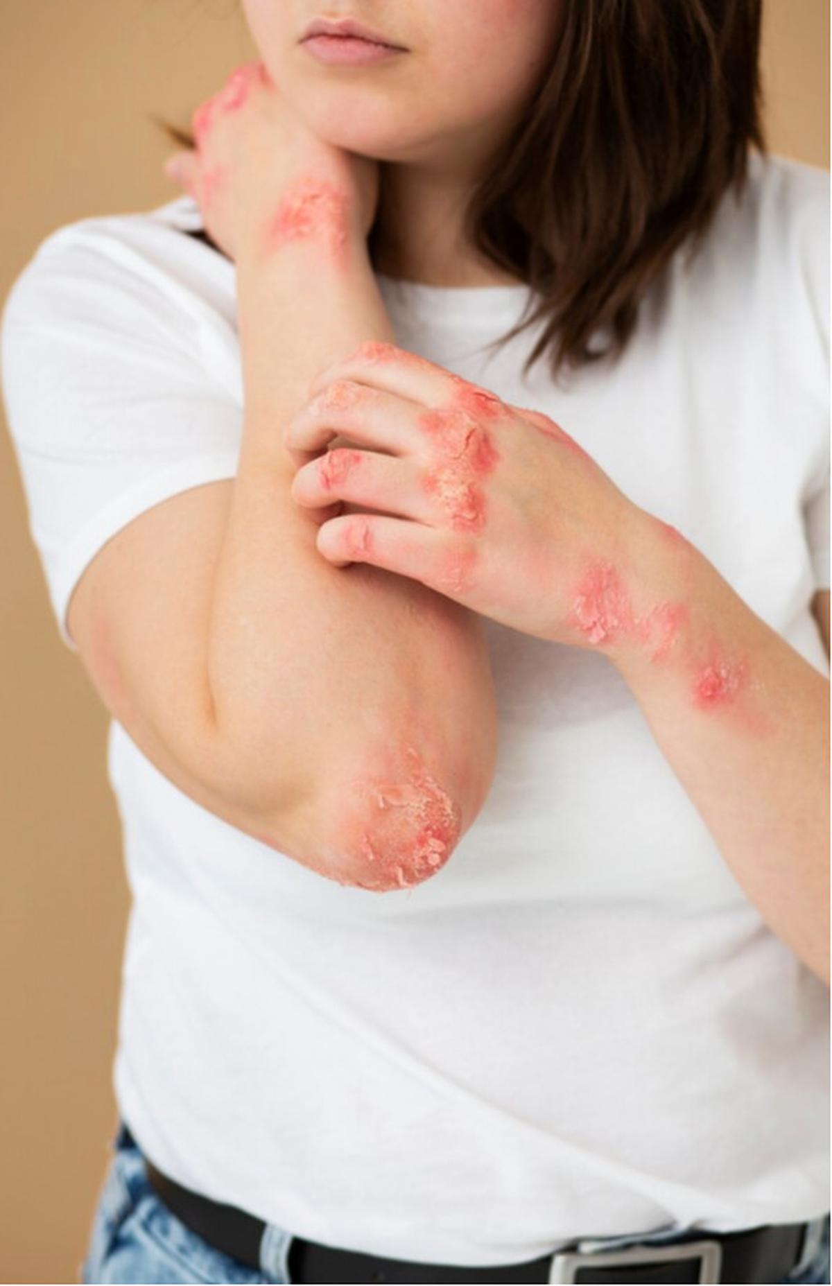 psoriasis