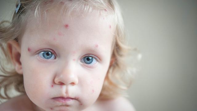 Cacar air (iStockphoto)