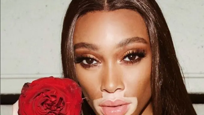 Mengidap Vitiligo, Winnie Harlow Terpilih Tampil di Victoria's Secret Show