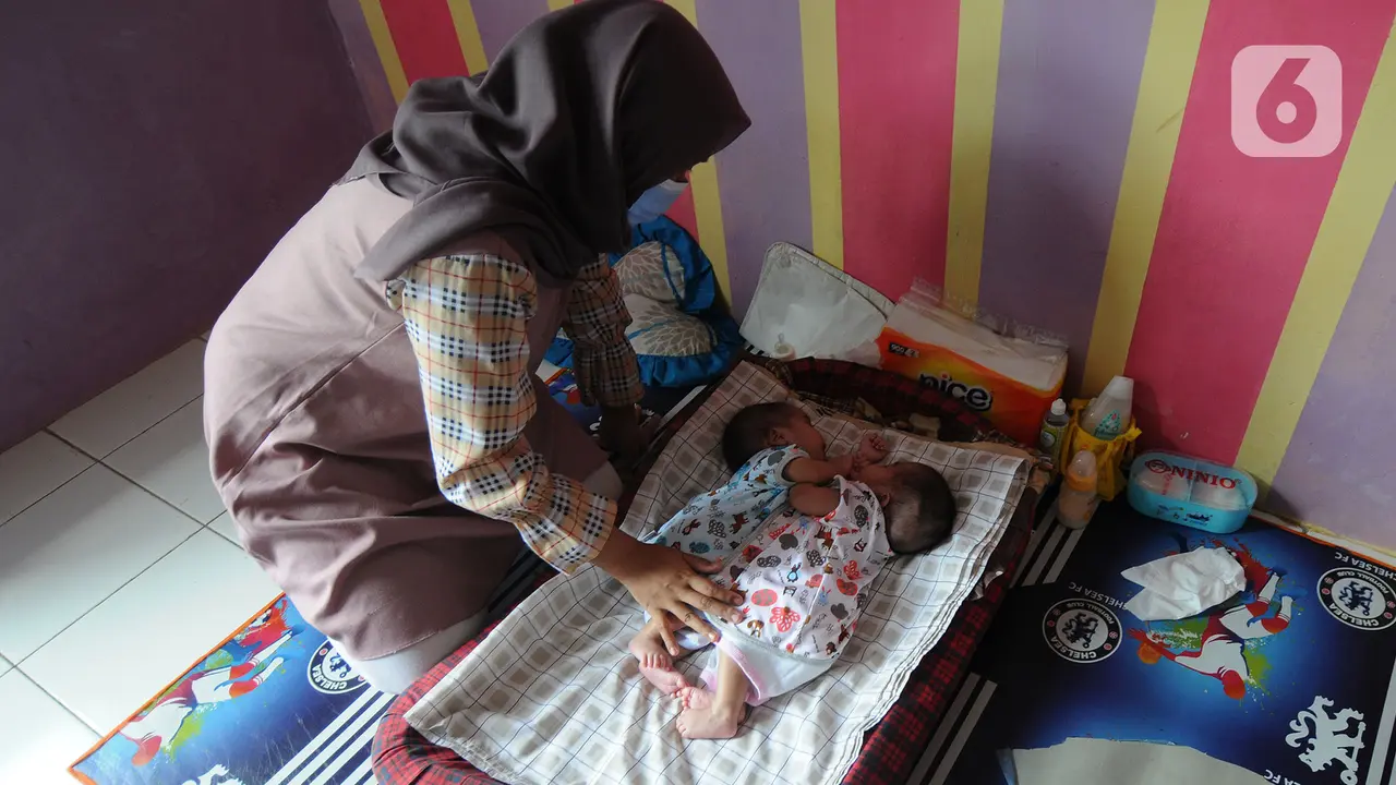 Bayi Kembar Siam di Sukabumi
