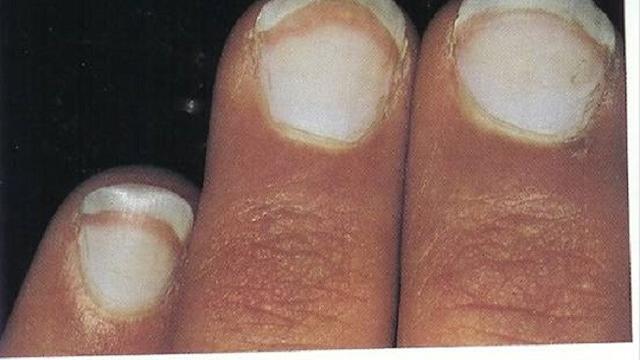 4 Tanda Putih Pada Kuku