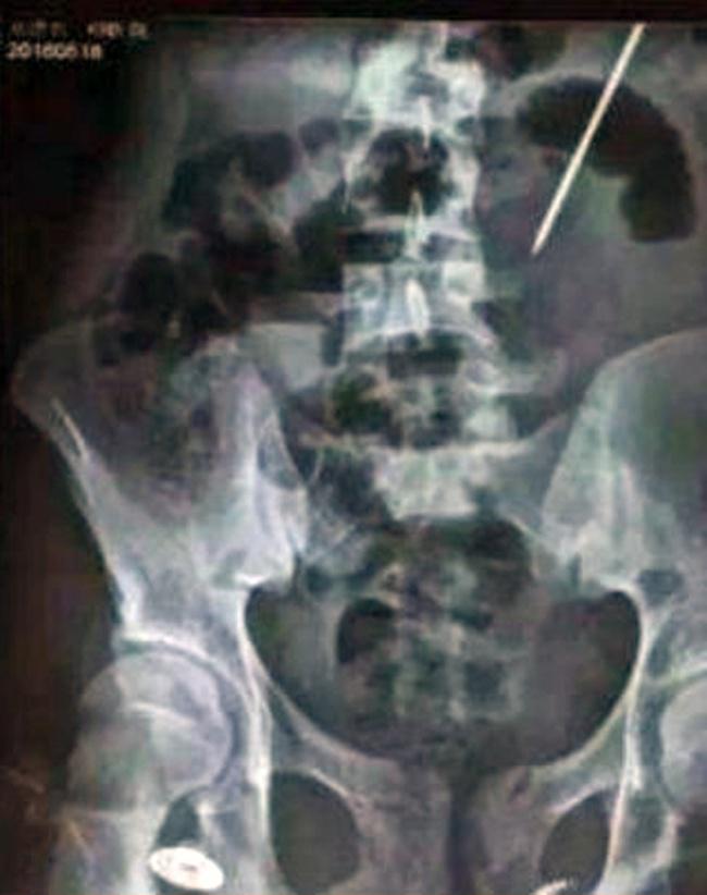 Paku bersarang di tubuh pria setidaknya selama 2 bulan terakhir | Photo: Copyright  singaporeseen.stomp.com.sg