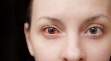 8 Penyebab Sakit Mata Merah Sebelah dan Cara Mengobatinya, Perlu Diperhatikan