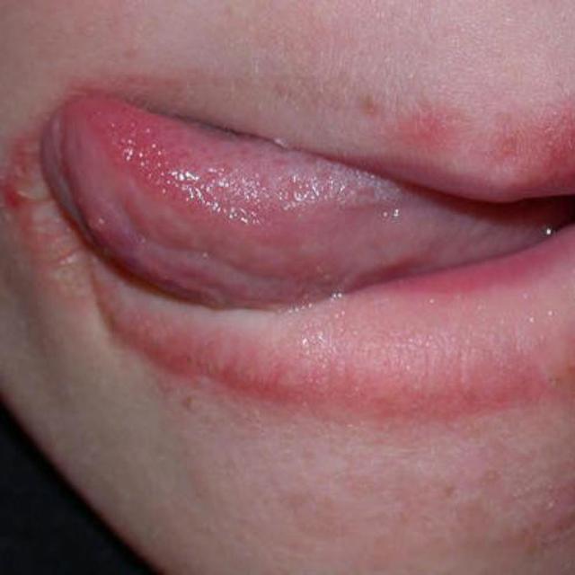 Apa Yang Sebabkan Kulit Di Sudut Bibir Kering Health Liputan6 Com