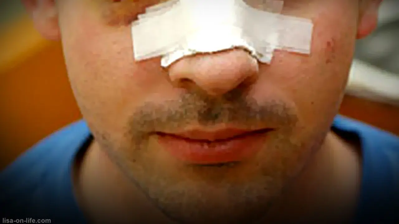 broken-nose-130802b.jpg