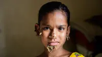 Sahana Khatun ditemui saat menjalani perawatan di sebuah rumah sakit di Dhaka, Bangladesh, 30 Januari 2017. Gadis 10 tahun tersebut tengah dirawat karena mengalami kondisi langka yang dikenal sebagai sindrom "manusia pohon". (STR/AFP)