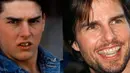 Tom Cruise memutuskan untuk memutuskan untuk melakukan perawatan kawat gigi di usia 40 tahun. (Plastic Surgery)