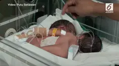 Bayi kembar siam dempet lahir di Bali dari pasangan Syamsudin dan Asini.