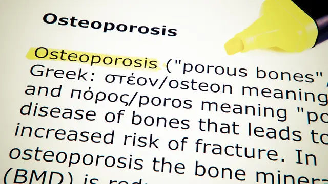 Osteoporosis (iStockphoto)