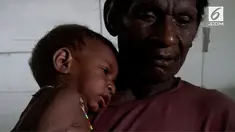 Campak dan gizi buruk yang terjadi di Kabupaten Asmat, Papua terus meluas. Wabah ini telah masuk kategori kejadian luar biasa.