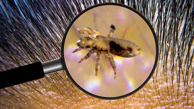 Cara Ampuh Membasmi Kutu Rambut dan Telurnya yang Bikin Kepala Gatal, Intip Yuk
