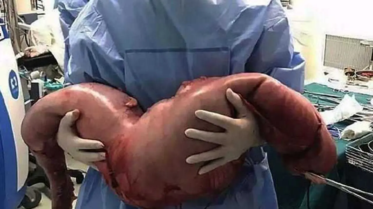 Tak Bisa BAB, 28 Kg Kotoran Dikeluarkan dari Tubuh Pria Ini