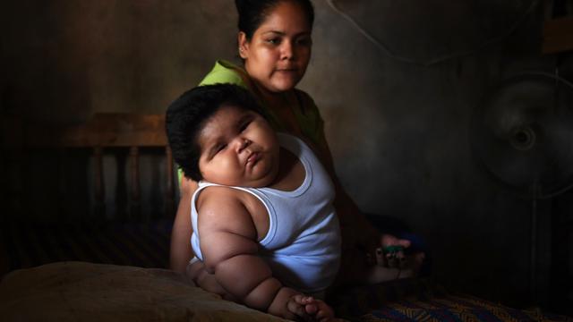 Berat 28 Kg, Bayi 10 Bulan di Meksiko Alami Obesitas