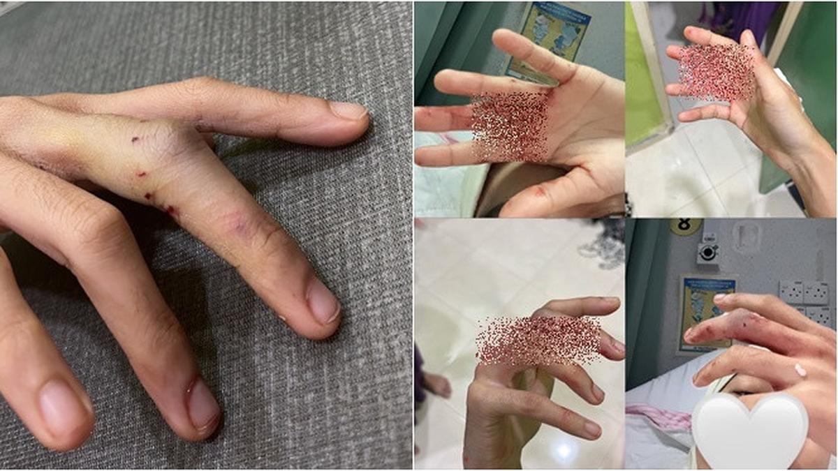 Ular Sanca Gigit Paha dan Jari Gadis Ini saat Buang Air, Darah Bercucuran