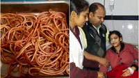 Sakit Perut, 150 Cacing Dikeluarkan dari Perut Wanita Ini