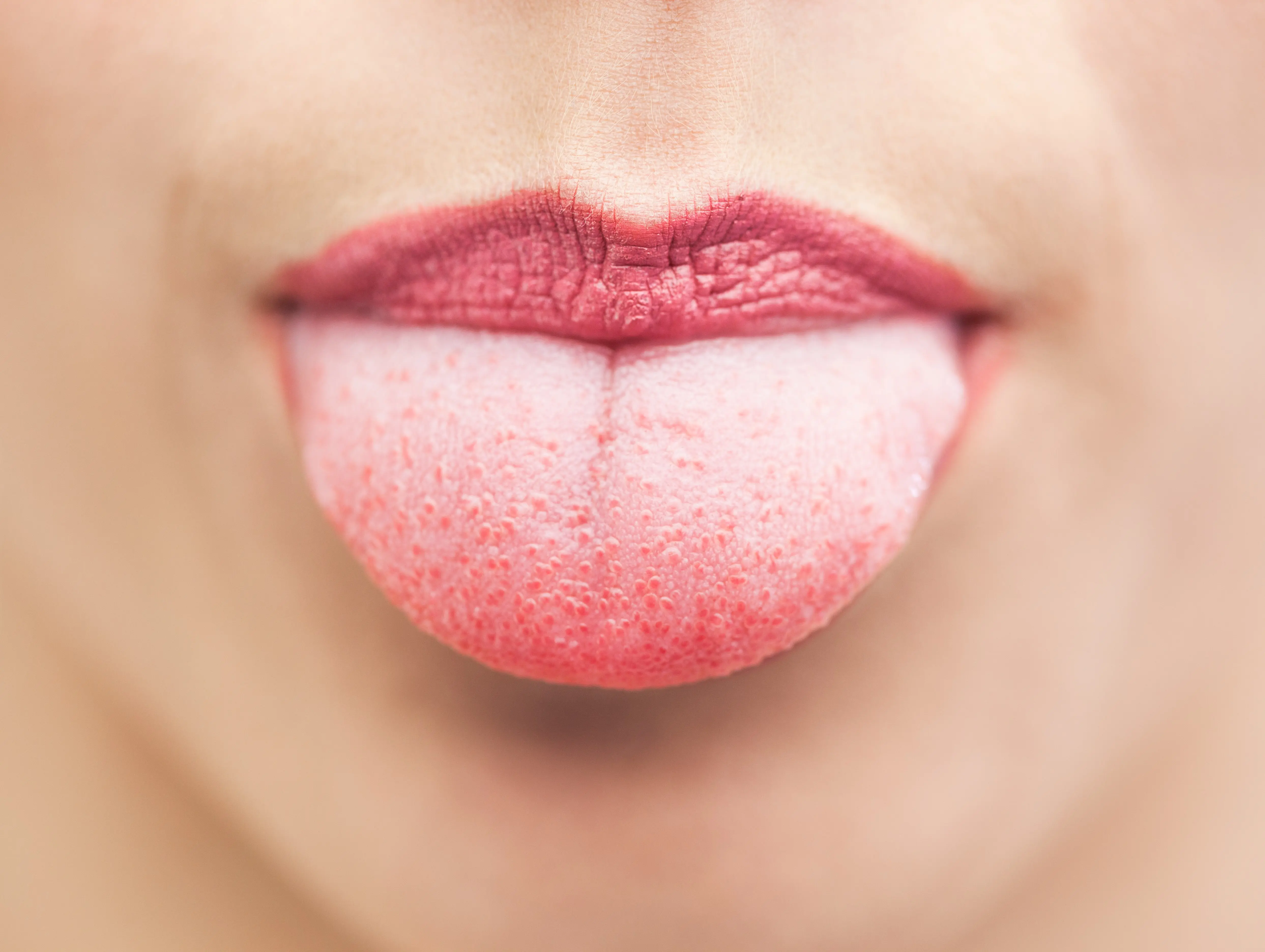 Beberapa gejala kanker lidah ini sering disepelekan oleh si penderita. Kamu juga harus waspada! (Foto: images.medicaldaily.com)