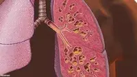Implan Lever Lebih Baik dari Donor yang Masih hidup