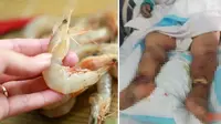 Terluka Saat Bersihkan Udang, Lansia Ini Alami Infeksi hingga Meninggal